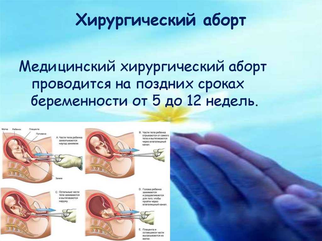 К чему снится выкидыш: сон о живом эмбрионе, потеря ребёнка с кровью перед родами, значения в сонниках