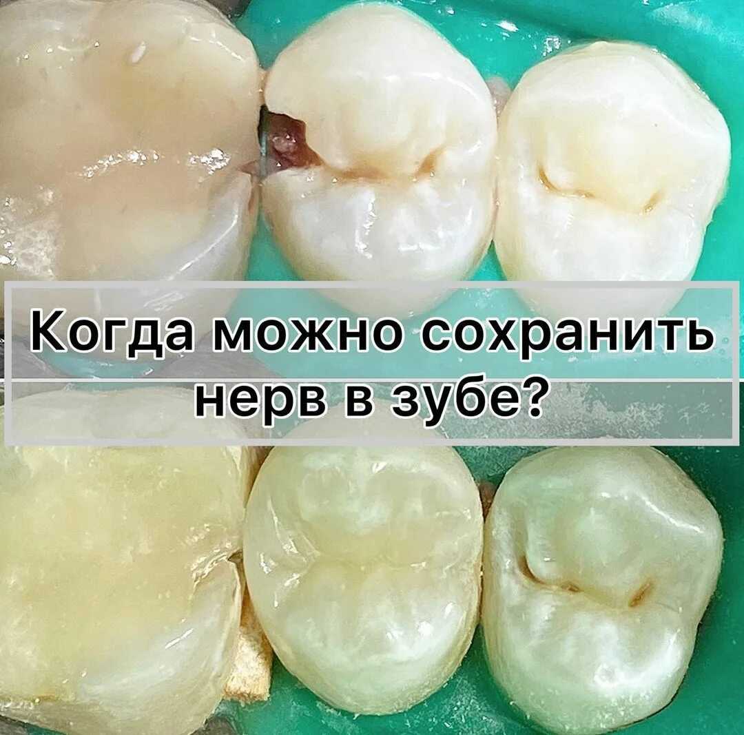 К чему снится сломанный зуб?